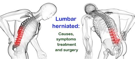 What Is Lumbar Herniated Disc Causes Symptoms And Treatment