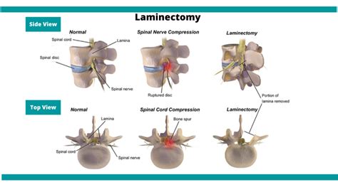 Laminectomy Or Spinal Decompression Surgery In Mumbai Dr Bhavin Shial