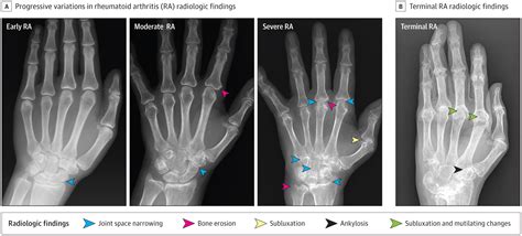 Disorganization of the joint leads to deformities and loss of function. Diagnosis and Management of Rheumatoid Arthritis: A Review ...