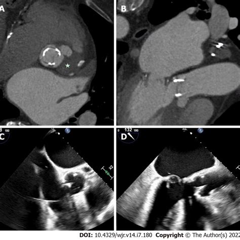 Mechanical Aortic Valve Infective Endocarditis With Aortic Root