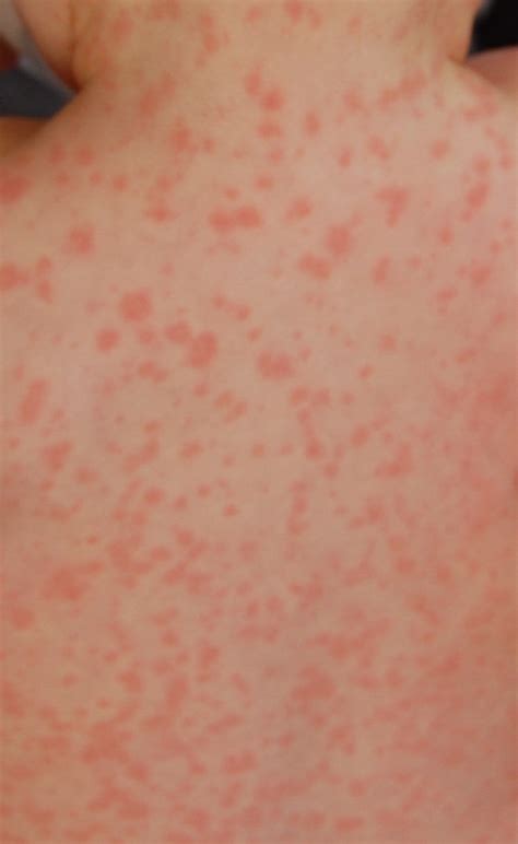 Itchy Bumps Under The Skin On Arms Naturally What Causes Red Spots On