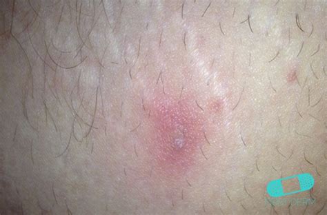 Abscess - Online Dermatology