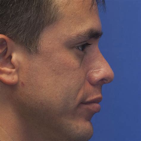 Short Upturned Tip Rhinoplasty In Seattle Rhinoplasty Surgeon