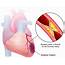 Myocardial Infarction  Understanding And Definition Of