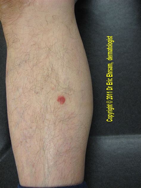 Dermoscopy A Red Tumor On A Leg