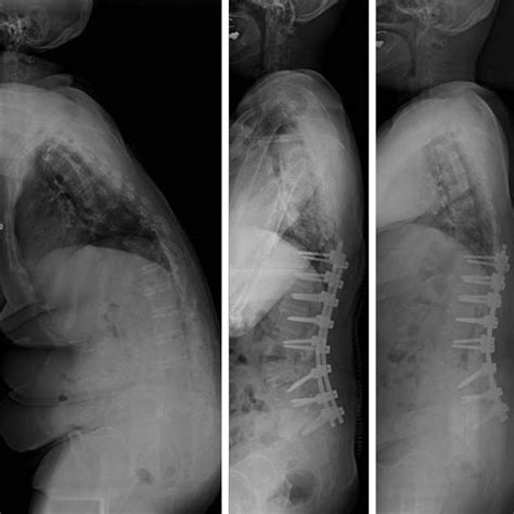 A 62 Year Old Woman With Lumbar Degenerative Kyphosis A Preoperative