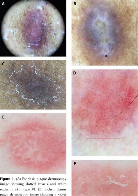 Figure 1 From Dermoscopic Features Of Psoriasis Lichen Planus And