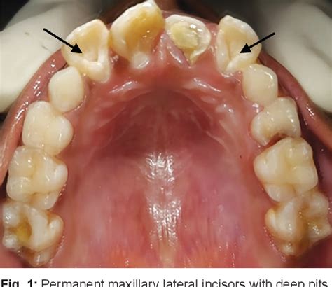 Figure From Occurrence Of Dens In Dente In Permanent Maxillary
