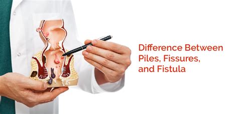 Difference Between Piles Fissures And Fistula Nh Assurance