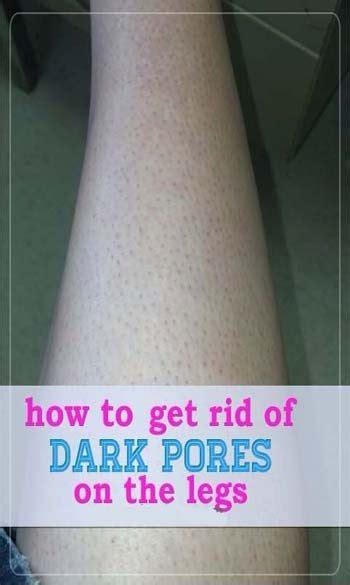 How To Get Rid Of Dark Pores On The Legs Dark Pores Beauty Remedies