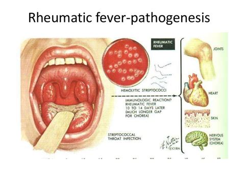 Rheumatic Fever