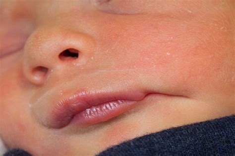 Unilateral Macrostomia In The Newborn A Rare Congenital Anomaly Of The