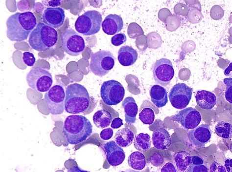 MCL-1 inhibitors could prove effective against multiple myeloma