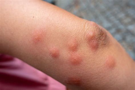 bed bug bites pictures symptoms what do bed bug bites look like ph