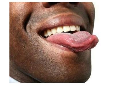 3 Causes Of Tongue Cracks
