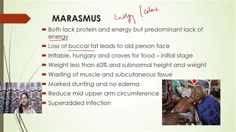 Malnutrition Protein Energy Malnutritionpemmarasmus