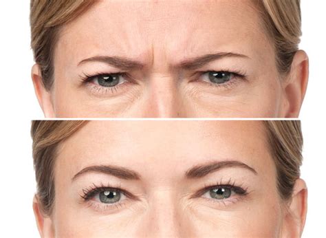 Botox 00 Radiant Dermatology