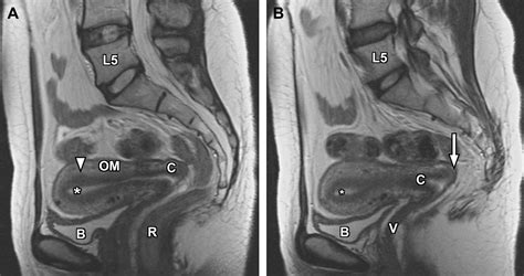 Normal And Variant Pelvic Anatomy On Mri Magnetic Resonance Imaging