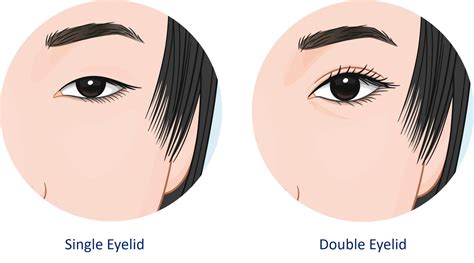 Incisional Vs Non Incisional Double Eyelid Surgery In Singapore