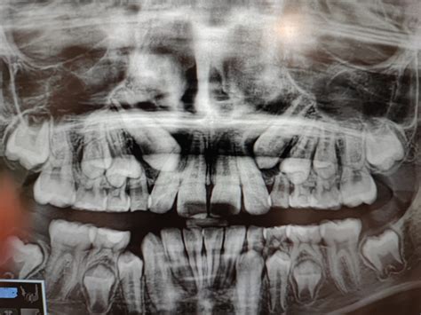 La Importancia De Realizar Radiografías A Los 6 Años Centre Dental M