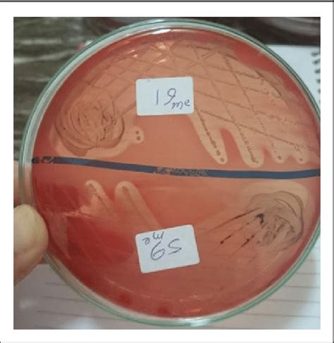 Haemolysis Of Saureus On Human Blood Agar Plates Download