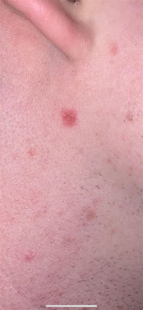 Should This Reddish Mole On My Neck Be Checked Out Or Does It Look Fine