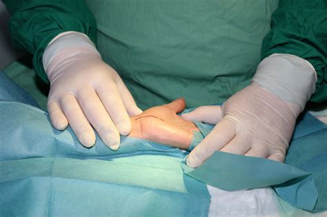 Kenapa Perawatan Dengan Pembedahan Tangan Diperlukan Jual Kaki Palsu Tangan Dan Jari Palsu