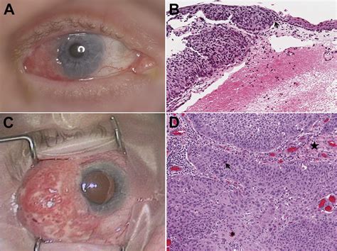 Histologic Changes In A Squamous Cell Carcinoma Of Conjunctiva