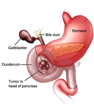 People who have it usually receive the diagnosis when it's in an advanced stage. عانت من اليرقان فاكتشفت ورم في البنكرياس | حكيم