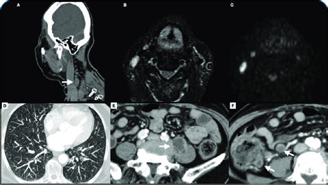 Ct And Mri Of The Neck Showing Lymph Node Enlargement In The Right