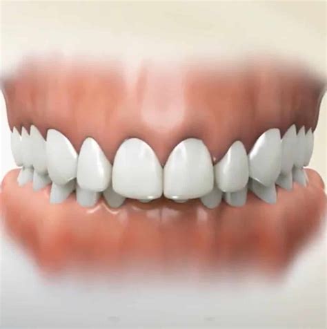 Overbites Why Do They Need Correction Peak Orthodontics