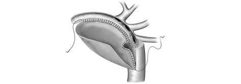 Arch Reconstruction In Hypoplastic Left Heart Syndrome Handling The