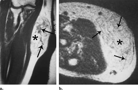 Subcutaneous Atypical Lipomatous Tumorwell Differentiated Liposarcoma