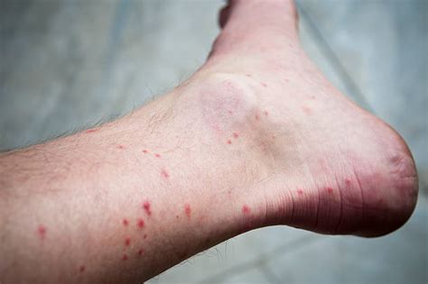 550 Insect Bites On The Legs Stock Photos Pictures And Royalty Free