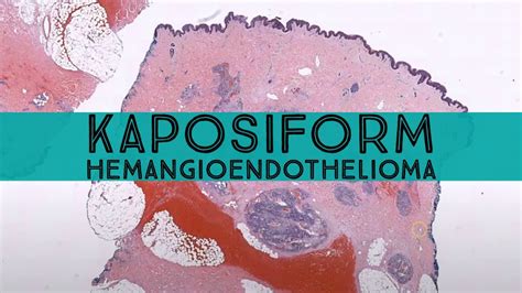 Tufted Angiomakaposiform Hemangioendothelioma Pathology Dermpath