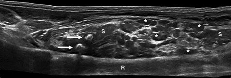 Ultrasound Evaluation Of Pediatric Slow Flow Vascular Malformations