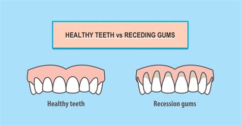 5 Main Causes Of Receding Gums Gum Recession Suburban Essex