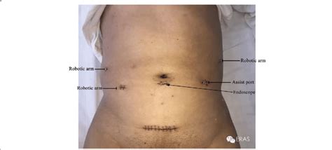 Locations Of The Abdominal Incisions In The Patient Download