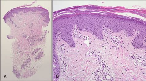 A Marked Hyperkeratosis And Mild Acanthosis With Mild Inflammatory