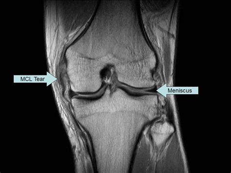 Mcl Tear On Coronal Mri Of Knee Magnetic Resonance Imaging Magnetic