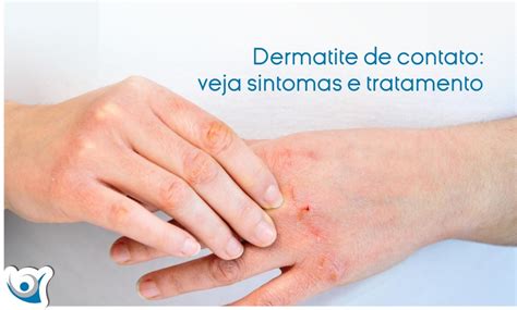 Dermatite De Contato Veja Sintomas E Tratamento Alergocl Nica