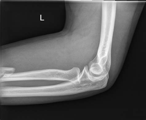 Displaced Radial Shaft Fracture With Radial Head Dislocation Image