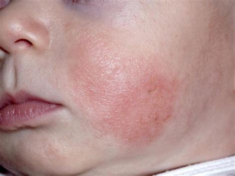 分辨宝宝湿疹，口水疹，尿布疹儿童皮疹及各种皮肤状况的特征（附照片慎入）