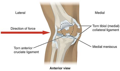 Knee Injuries From Car And Motorcycle Accidents Settlements And More