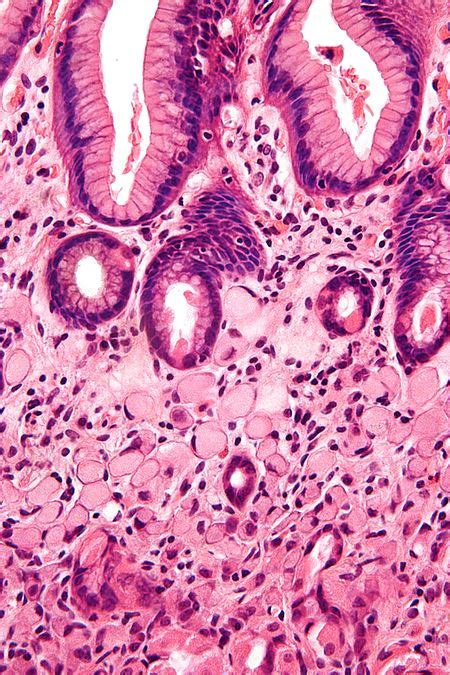 Stomach Carcinoma Libre Pathology