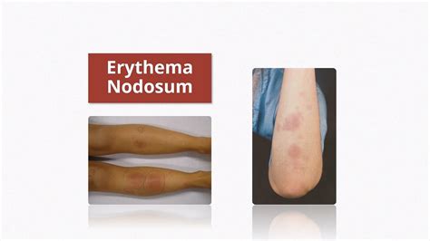 Erythema Nodosum Causes And Treatment Youtube