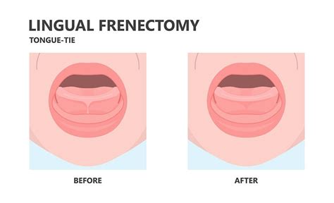 Phoenix Frenectomy Surgery Frenectomy Procedure