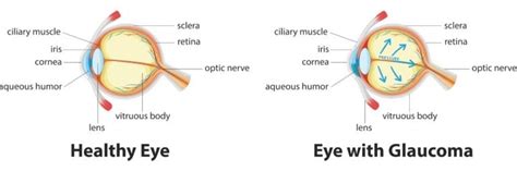 Glaucoma Vs Cataracts