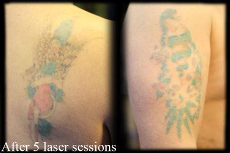 Can A Tattoo Help With Hyperpigmentation On Arms Justinboey