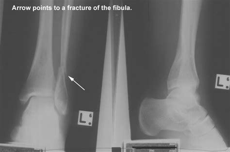 Spiral Fracture Fibula Surgery Types Symptoms And Treatment Of
